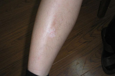 襄阳小腿患白癜风的症状表现有哪些