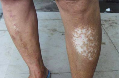 襄阳腿部白斑是白癜风的症状吗