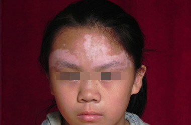 襄阳小孩白癜风初期在皮肤上都什么症状